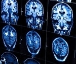 Study finds 'most horrible’ rare brain tumor patients falling through the cracks of mental health provision