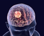 Study of immunotherapy for brain cancer metastases shows promising results